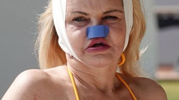 Danniella Westbrook Sunbathes with Bandages Around Her Head and Nose Out in Turkey (47 Photos)